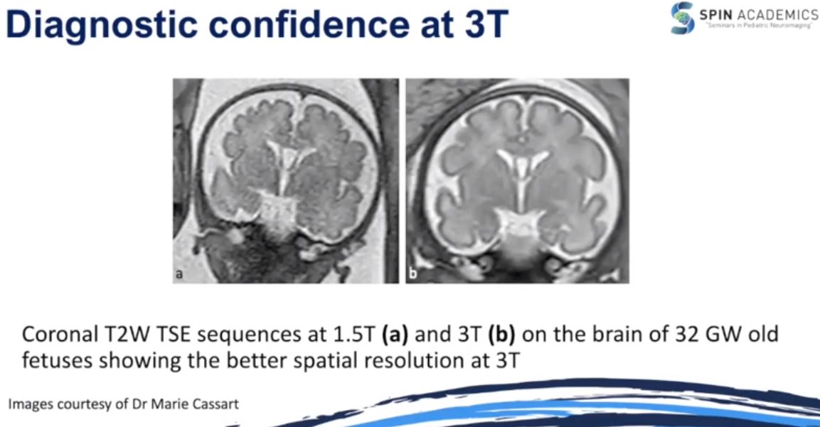 Dr Kish Mankad (@drmankad) on Twitter photo 3T for fetal imaging? By improving the SNR, 3T imaging improves diagnostic confidence argues <a href="/GColleranMD/">Gabrielle Ní Challaráin</a> at #SPIN21. Tweak the flip angle for better T1 quality she adds. Thank you Gabrielle for such a balanced approach to this ongoing debate. Full talk is a must listen! 3T for fetal imaging? By improving the SNR, 3T imaging improves diagnostic confidence argues <a href="/GColleranMD/">Gabrielle Ní Challaráin</a> at #SPIN21. Tweak the flip angle for better T1 quality she adds. Thank you Gabrielle for such a balanced approach to this ongoing debate. Full talk is a must listen!