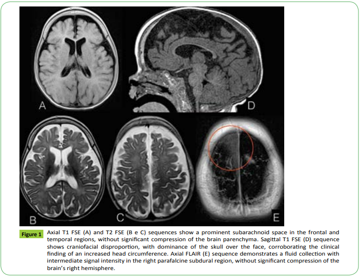medclinrev's tweet photo. Benign Macrocrania of Infancy (BMI) is a clinical entity of relative frequency in the first years of life. 

To know more about this article access: https://t.co/MvWjJcMJ1r

#Hematomas #Macrocrania #Infancy https://t.co/0QsOhuFwGn