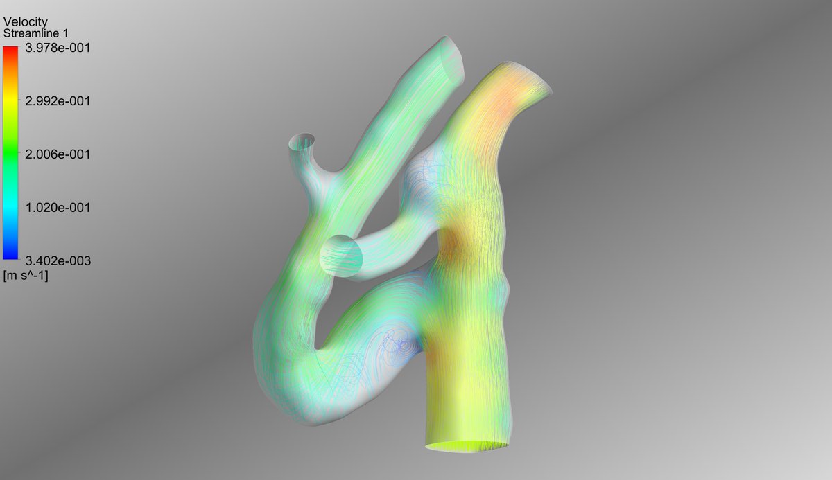FetchCFD's tweet photo. Simulation of blood flow inside Aneurysm. Check here: https://t.co/yGOG440343 #CFD #Simulation #FetchCFD #SimulationPlatform #Aneurysm #ComputationalFluidDynamics #FlowSimulation #CFDModeling https://t.co/FtVCSvMkxS