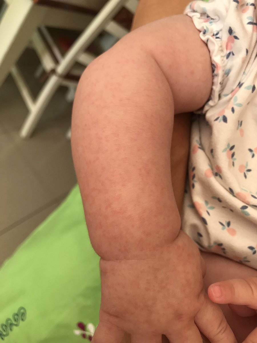 julianconejomir's tweet photo. Sudamina. También vulgarmente llamado “salpullido”. Algo frecuente en estos días de enorme calor. Producido por la obstrucción de las glandulas del sudor. @DermaHUVRocio https://t.co/fFsGzG6y9d
