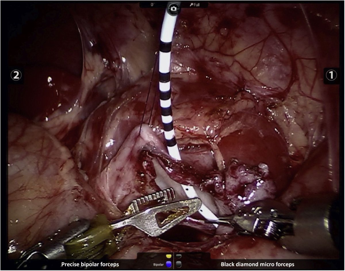 European Urology (@euplatinum) on Twitter photo Infant Robot-assisted Laparoscopic Pyeloplasty: Outcomes at a Single Institution, and Tips for Safety and Success
buff.ly/3yGM9mX
"Given the successful outcomes, decreased LOS, and improved cosmesis, RAL-P is an appealing option for UPJO in infants"
<a href="/AndolfiCiro/">Ciro Andolfi</a> Infant Robot-assisted Laparoscopic Pyeloplasty: Outcomes at a Single Institution, and Tips for Safety and Success
buff.ly/3yGM9mX
"Given the successful outcomes, decreased LOS, and improved cosmesis, RAL-P is an appealing option for UPJO in infants"
<a href="/AndolfiCiro/">Ciro Andolfi</a>
