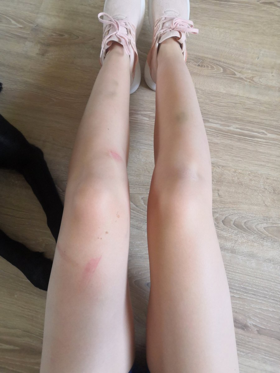 DoddererNastya's tweet photo. Я: так лето, можно ходить с голыми ногами
Мои ноги: https://t.co/r9fqlwfdwq
