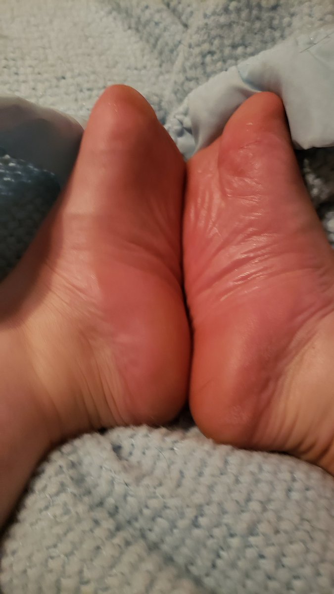 CJiorn's tweet photo. #feetgal #dmme #contentmarketing  #specialfeet #uniquefeet #feet #feettreat #foot #amputeegirl https://t.co/tJWFscz4yI