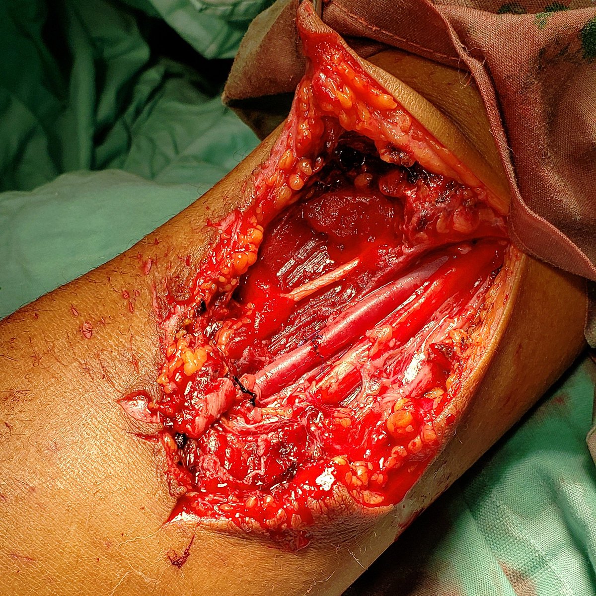 🥼🪡 Herida por pico de botella con lesión de arteria braquial, reparo con anastomosis término-terminal
#surgery #generalsurgery #cirugia #some4surgresident #some4surg #some4surgery #traumasurgery #trauma #lovesurgery #cirugiaunivalle #cirugíageneral #univalle #medicine #anatomy