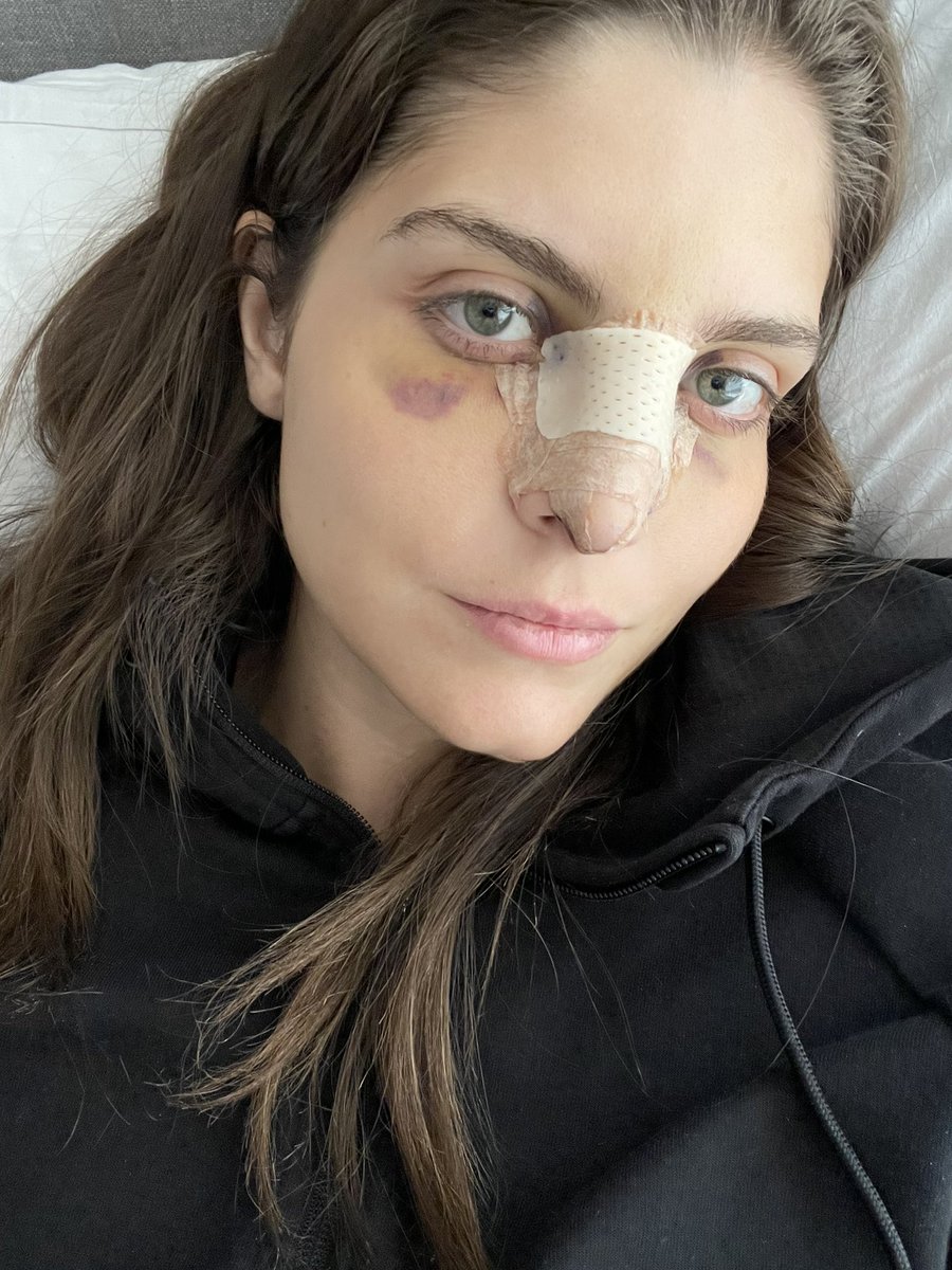 holasunshinee's tweet photo. Día 4 • me mareo a ratos pero CERO dolor, solo incomodidad.

Estoy IMPAKTDA de mis ojos blancos oxigenados 🥺🤩

Ya me puedo sonar y me salieron muchas cosas extremas de mi nariz🤣 creo que hasta salió un pedazo de cartílago o no se que era eso pero casi me desmayo del CHOCK JAJ https://t.co/pqjq1ekJn2