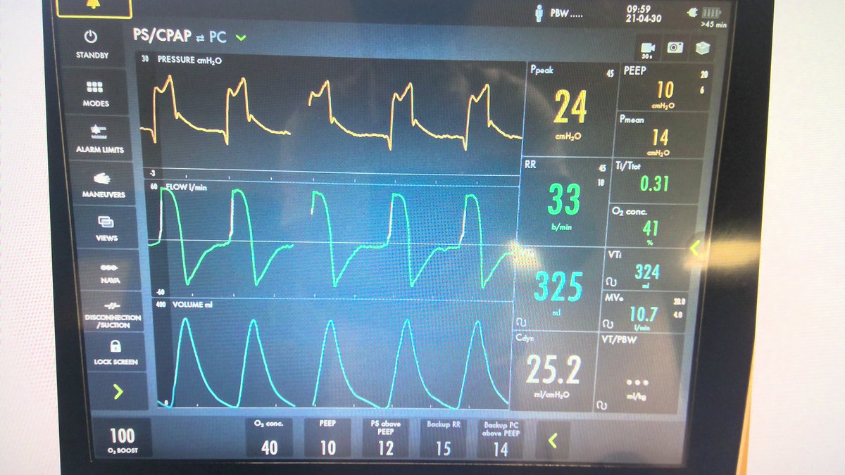 What is the issue here? lets discuss @ SEVA VentRounds tomorrow at 2 PM EST. live, free, all invited. link my.clevelandclinic.org/departments/re…
<a href="/msiuba/">Matt Siuba</a> <a href="/DrivingPressure/">Gustavo Cortes-Puentes, M.D.</a> <a href="/some4mv/">@SoMe4MV</a> <a href="/CCF_PCCM/">CCF Pulmonary and Critical Care Fellows</a> <a href="/Thind888/">Aman Thind</a> <a href="/BasselAkbik/">Bassel Akbik</a> <a href="/VashishtRishik/">Rishik Vashisht</a> <a href="/Donicme/">Nikhil Meena</a> <a href="/CommecOficial/">Colegio Mexicano de Medicina Crítica, A.C.</a> <a href="/BrianKWalsh/">Brian Walsh PhD RRT</a> <a href="/MegriMohammed/">Mohammed Megri. MD</a> <a href="/kdlamb1/">Keith D. Lamb, RRT-ACCS, FAARC, FCCM</a>