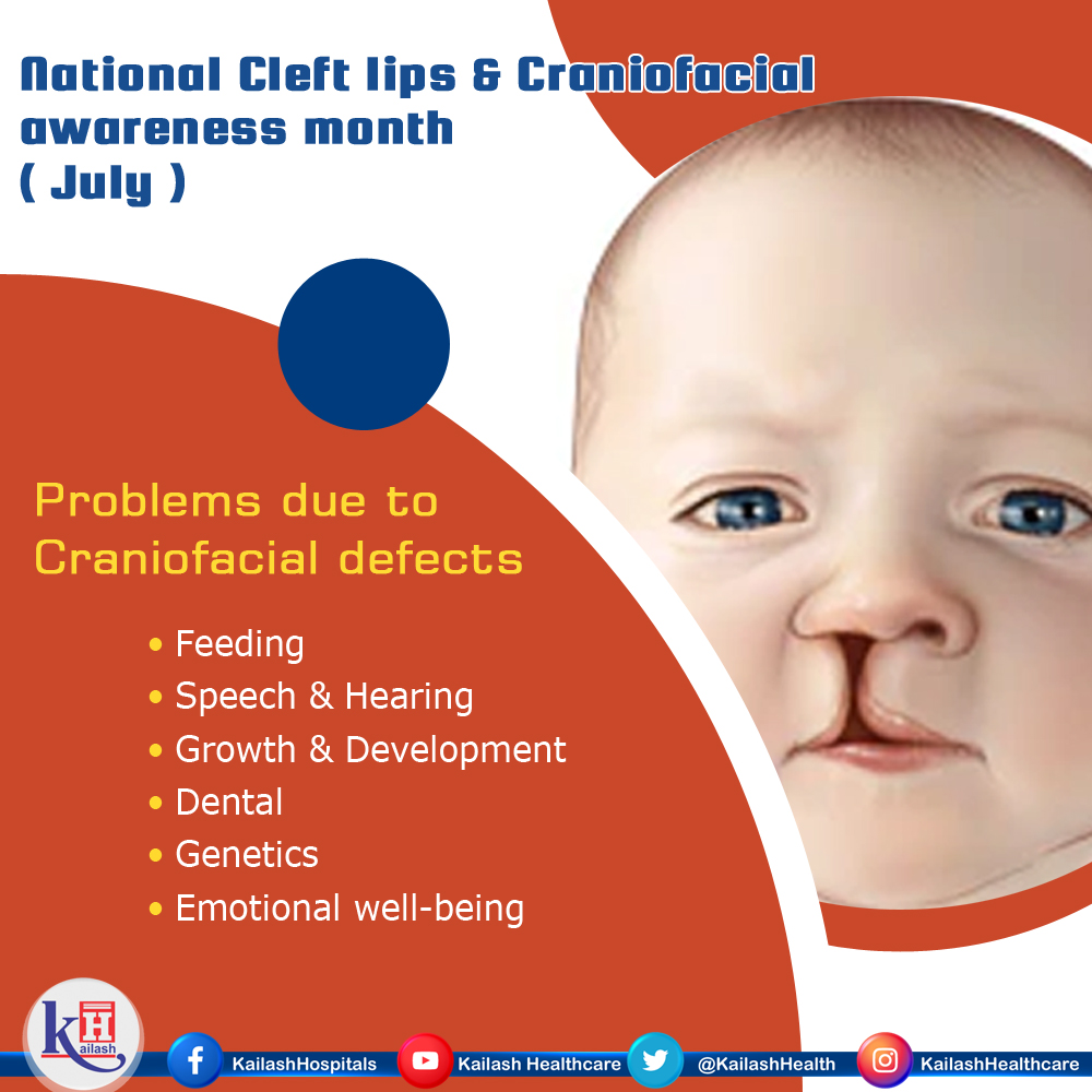 Children with Cleft or Craniofacial disorders experience  problems like feeding difficulties & ear infections until the problem is treated.

Consult our Paediatricians: kailashhealhcare.com

#Cleftcraniofacialdisorder #Congenitaldisorders #Birthdefects #folicacidinpregnancy