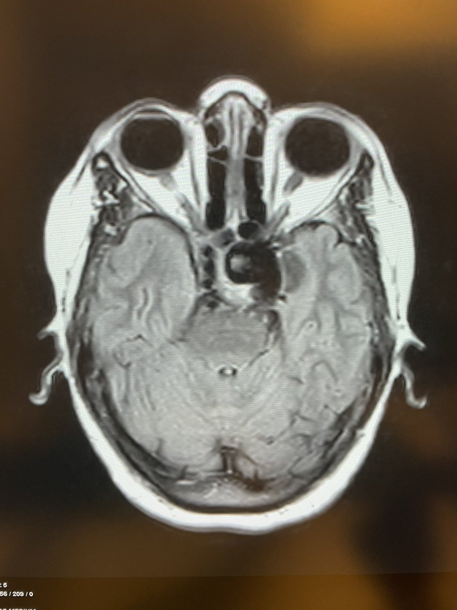 The patient presented with a third nerve palsy, how would you treat this? Which first?