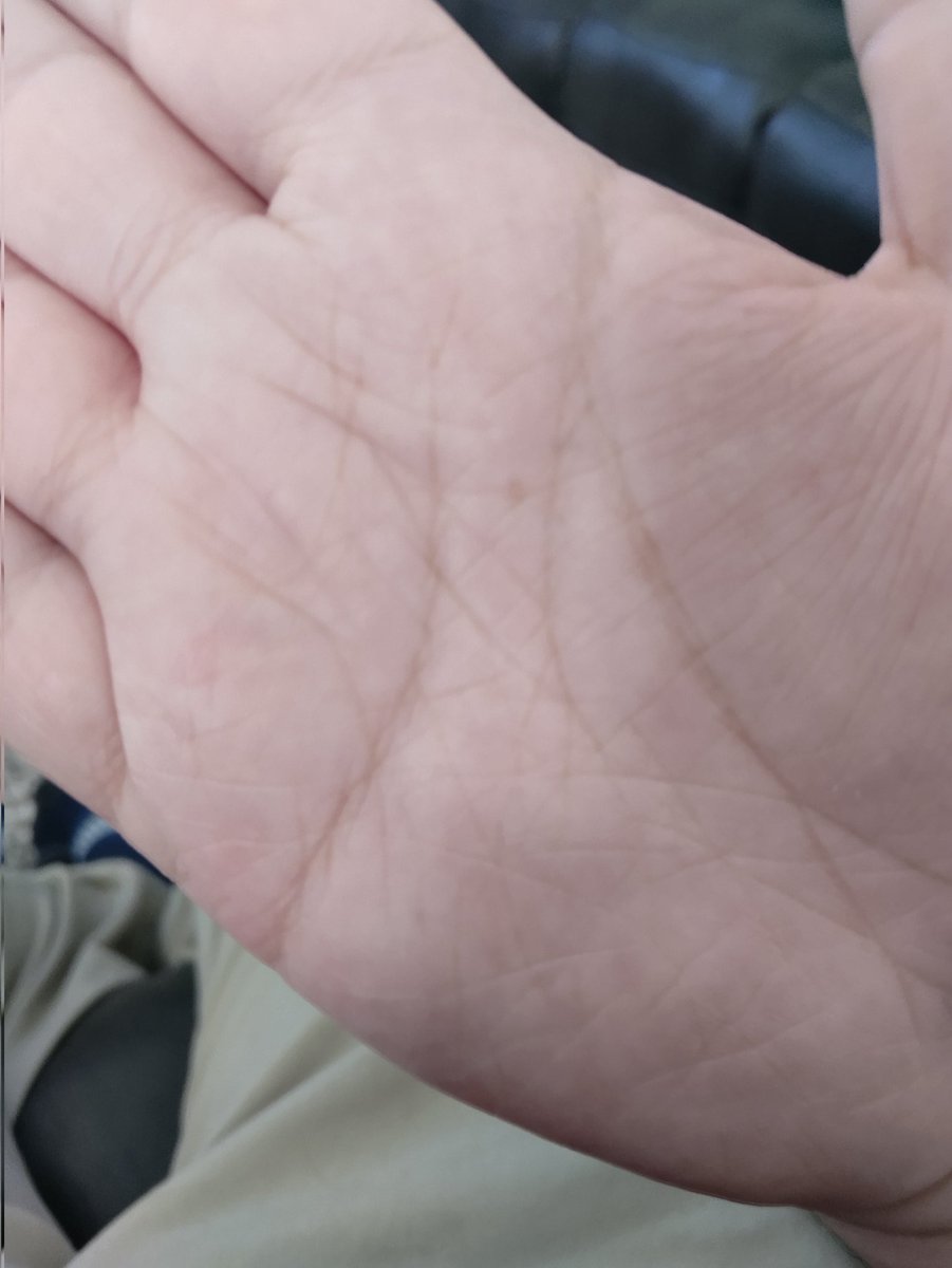 The_McStick's tweet image. So I have seen that the &quot;M&quot; shape is important in palm reading, but what does it mean if I got two? my right hand is dominant, but I was ambidextrous as a toddler. #palmreading #palmology #palmstudy