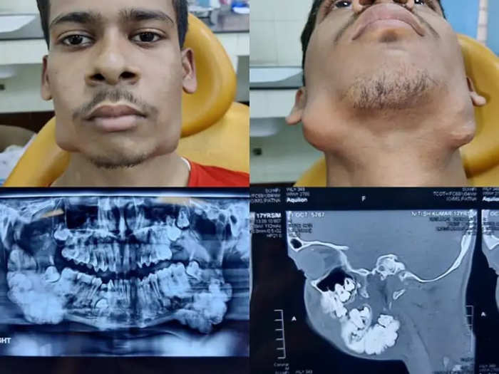 VForViral1's tweet photo. 17 year-old Teenager With Rare Tumour Has 82 Teeth Removed From Jaw In Three-Hour Operation https://t.co/gIFyCReRYO