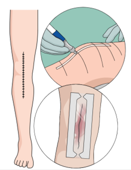 ArthroToday's tweet photo. #OrthoTwitter, what is your preferred closure method for #TJA? Check out this systematic review below. @DrLeeRubin @BoneDocMMD @AlexisGaskin32 @JennaBernstein7 @kimtuckinAZ @AAHKS 

https://t.co/zArkbvCFiE https://t.co/MQl9GvcC0H
