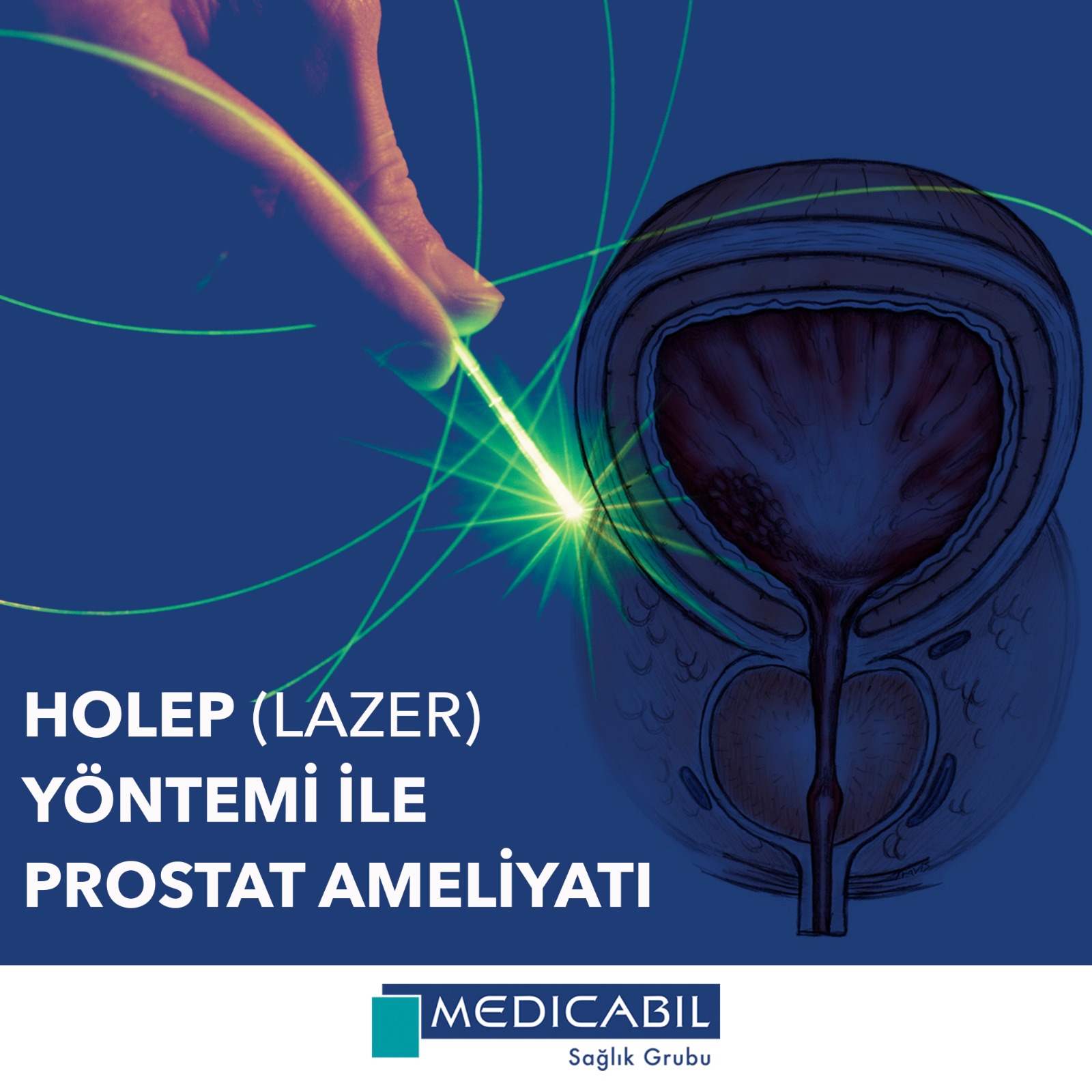 Lazerle Prostat Ameliyatı