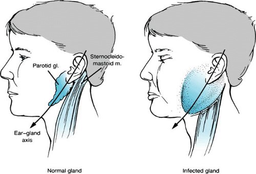 #tilt2: Clues to look for when trying to make diagnosis of parotitis - does it obscure the angle of the mandible? Gold standard for imaging is US. (Grateful for my very education-minded attending last night!) #pem #tilt