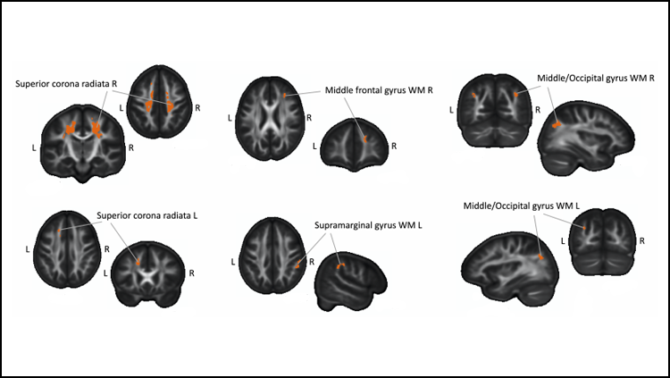 SfNJournals's tweet image. A new #JNeurosci study from @molendowska_m, @jmatuszewski2, @A_Marchewka_ et al. highlights how white matter reorganizes at specific time points to meet the needs of the brain when learning Braille.

jneurosci.org/lookup/DOI/10.…