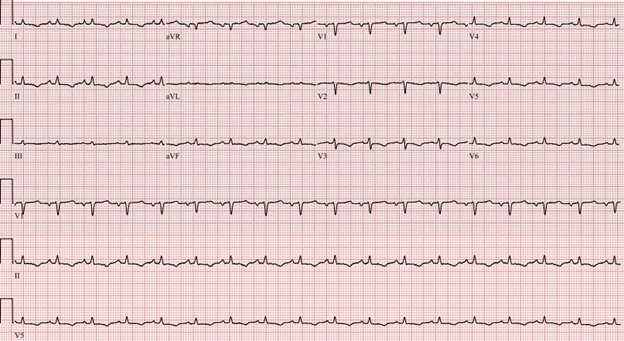 ACCinTouch's tweet photo. A 26 y/o male with no significant medical history consulted to the hospital for a 4-week period of shortness of breath and #anasarca. Based on the data from the ECG, #CMR, and echocardiogram, what would be the most likely diagnosis? https://t.co/yewRj4MaX9 #ACCEd https://t.co/K55weH75x0