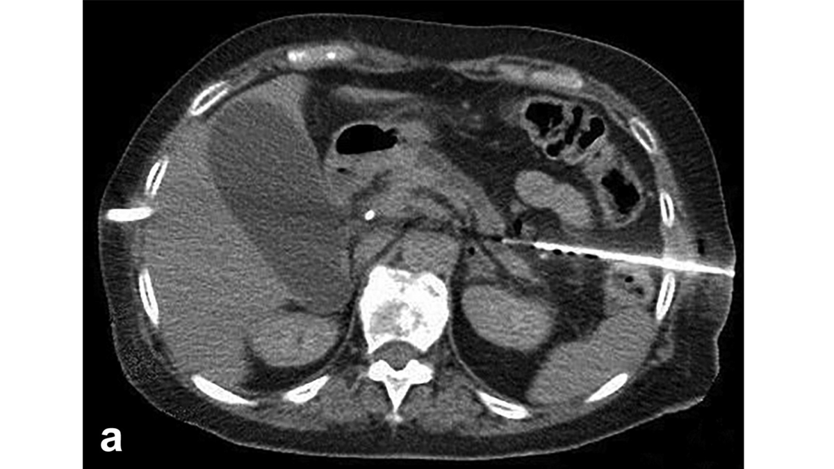 An observational study in July's <a href="/JVIRmedia/">JVIR</a> demonstrates that an obstructed pancreatic duct can be accessed and drained if an appropriate imaging guidance technique is selected. buff.ly/3yDawC7