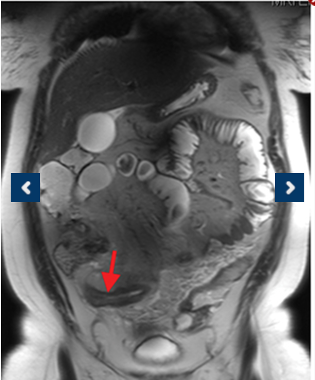 Applied_Rad's tweet photo. Compared to other diagnostic modalities, MR enterography is less dependent on bowel distention compared to optimal CTE & depicts submucosal pathology. Learn more in this SA-CME article > https://t.co/2Y71G4WE32 #Enterography #AbdominalImaging #Radiologists #BraccoImaging https://t.co/WWTEIPEEn2