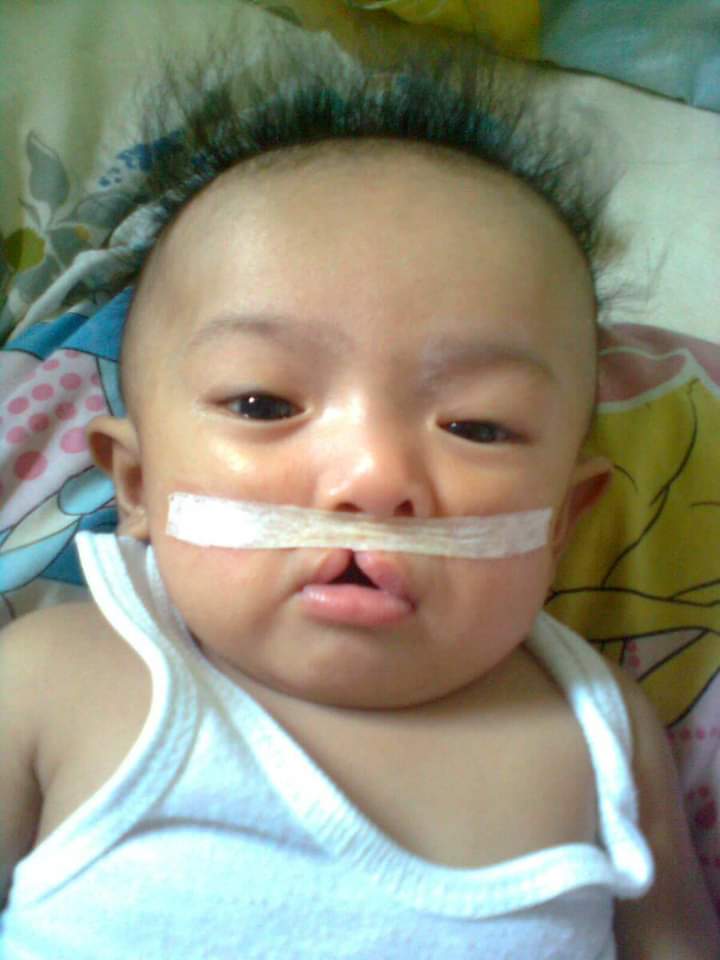 Please pray for my son Adrian Cleft Lip and Palate surgery today that he may surpass this surgery.
#AdrianJourneySinceBirth
#CleftLipAndPalate
#LastFinalOperation