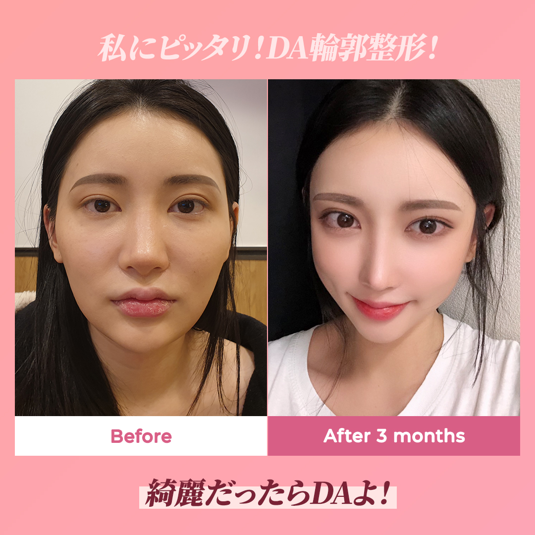 公式 韓国da整形外科 皮膚科 Da顔面輪郭 私に一番合ってる輪郭手術 格の違うdaの美しさをあなたに Vライン 顔面輪郭 可愛い 韓国人 輪郭 輪郭整形 輪郭手術 輪郭手術が上手な病院 両顎 両顎手術 ルフォー 目手術 目整形 鼻整形