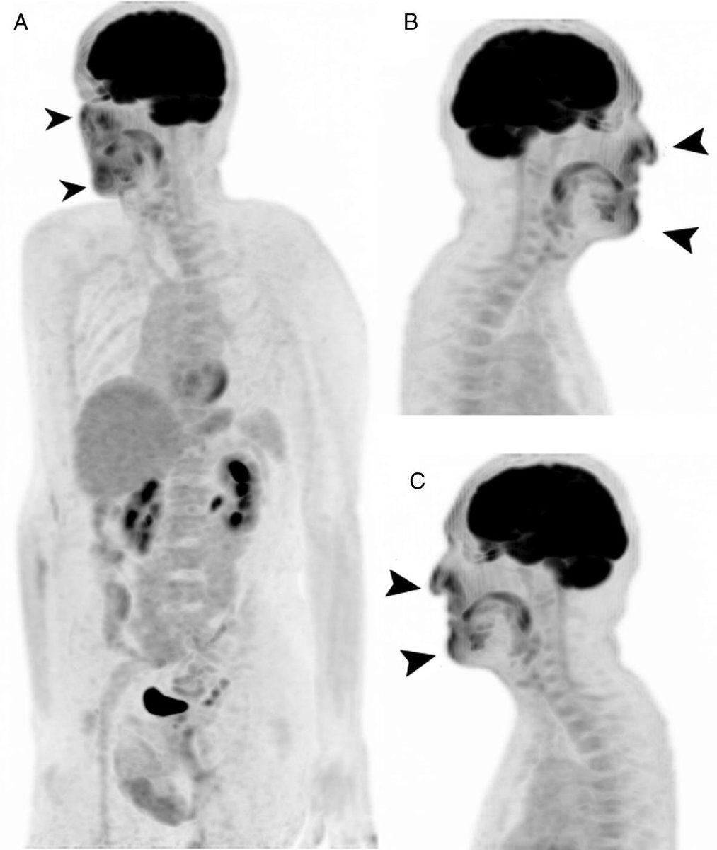 ClinNuclearMed's tweet photo. Current Issue: Infection Control of COVID-19: Surgical Mask–Related Facial Cutaneous Artifact on FDG PET/CT https://t.co/8Kxxz4AF7O https://t.co/Di6hGPLkkU
