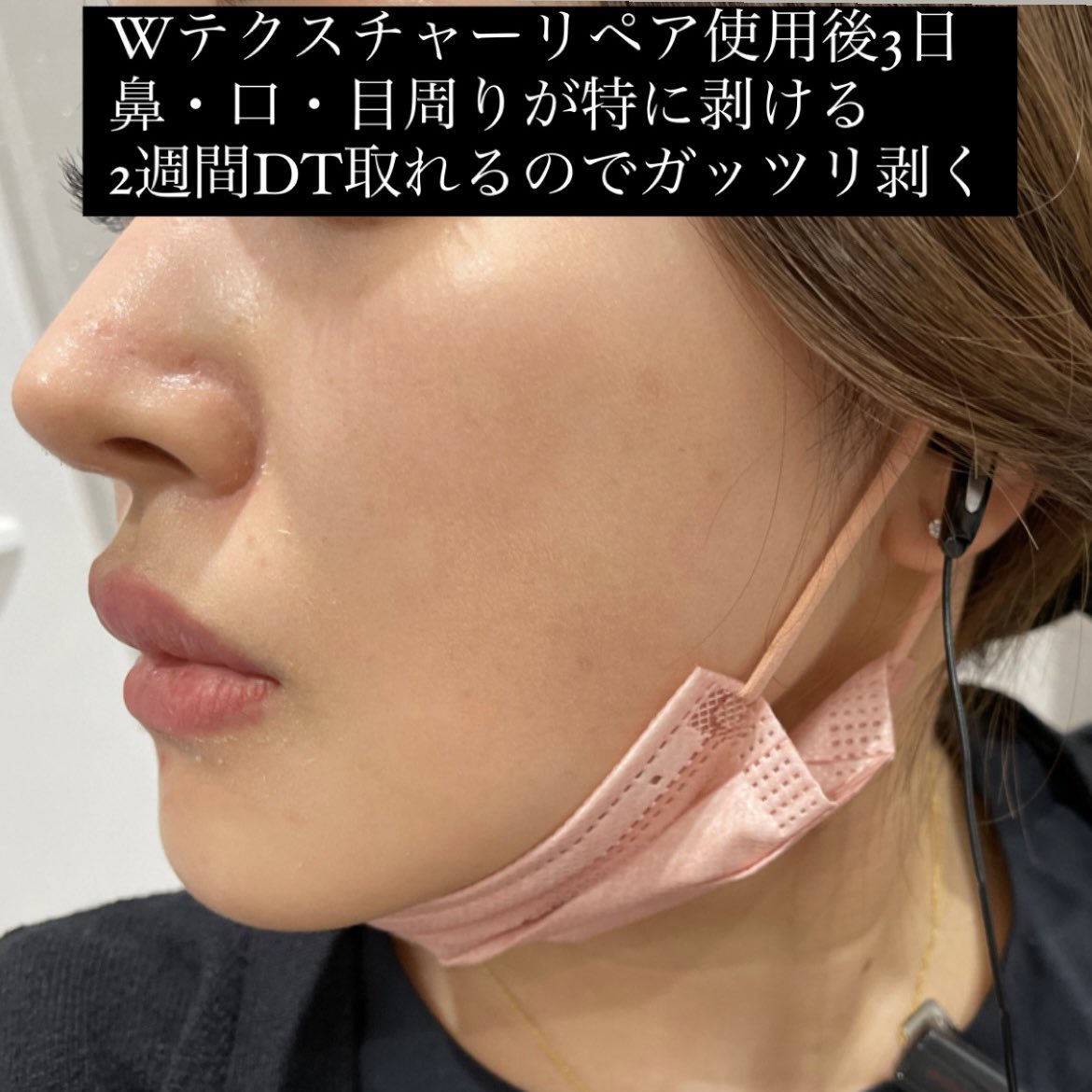 seikeibakari's tweet photo. よくお客様からも質問頂くので使ってるゼオスキンについて渾身のまとめ
正直皆がゼオ使っちゃうと美容皮膚科はレーザーの売上なくなるから複雑ではある🥲でも心から推奨

私はセラピューティックまでする勇気ないけど肌質は変えたい、
中リスク中リターンのコース
レチノールは肌状態と予定次第で選択 https://t.co/RWXasTCxj8