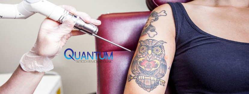 Quantum Tattoo Removal Clinic (@quantumclinicau) / Twitter Quantum Tattoo Removal Clinic (@quantumclinicau) / Twitter