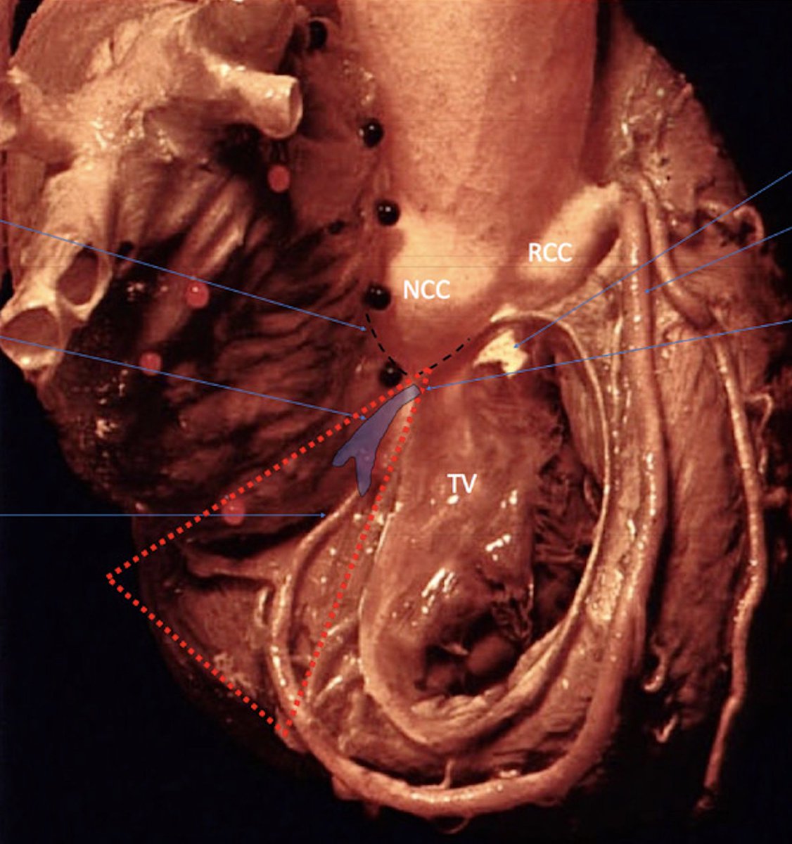 pzhong2016's tweet photo. Great anatomic picture collections for reference (His bundle conduction system) https://t.co/nUozUuTR2m
