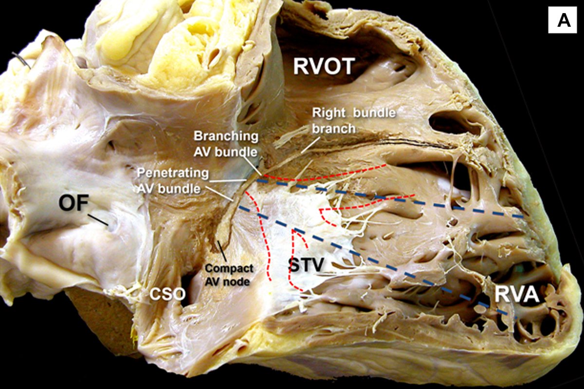 pzhong2016's tweet photo. Great anatomic picture collections for reference (His bundle conduction system) https://t.co/nUozUuTR2m