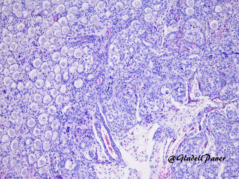 Gladell Paner, MD tweet media