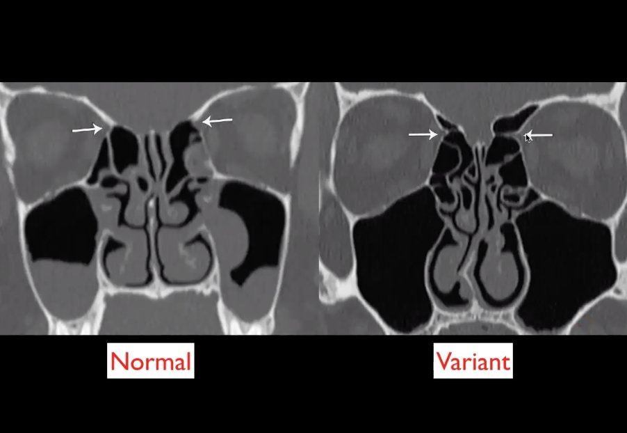 Tim Luijkx (@timluijkx) on Twitter photo <a href="/JennyKHoang/">Dr Jenny Hoang</a> at #Radiopaedia2021: mention anatomical variation in preparation of endoscopic paranasal sinus surgery (FESS) such as nasal septal deviation (requiring septoplasty), lamellar anatomy (avoid CSF leak), and location of anterior ethmoidal artery (avoid orbital bleeding) <a href="/JennyKHoang/">Dr Jenny Hoang</a> at #Radiopaedia2021: mention anatomical variation in preparation of endoscopic paranasal sinus surgery (FESS) such as nasal septal deviation (requiring septoplasty), lamellar anatomy (avoid CSF leak), and location of anterior ethmoidal artery (avoid orbital bleeding)