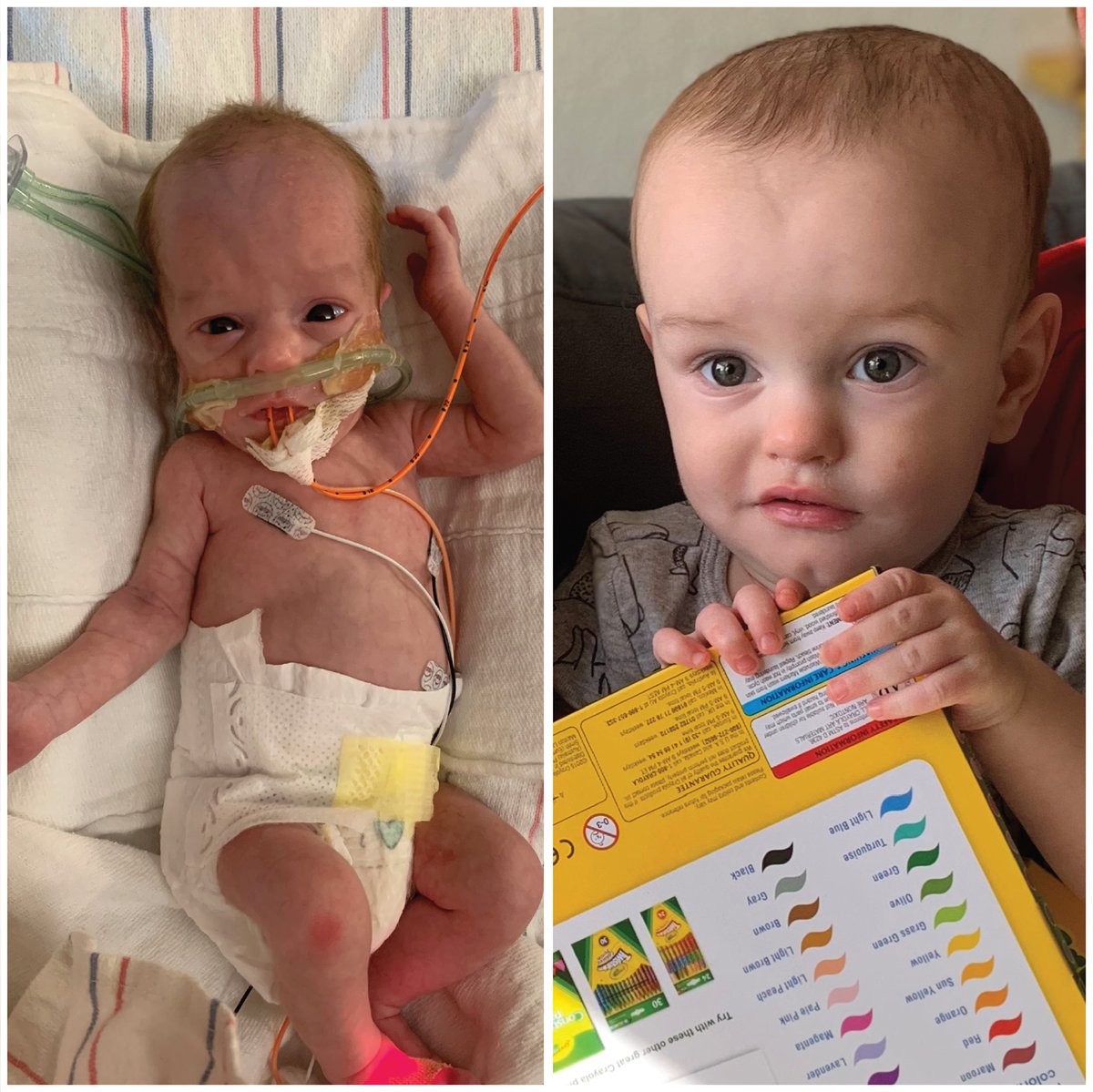 RMHGlobal's tweet image. It&apos;s #TransformationTuesday! Gus was born weighing only 1lb 15oz. While he grew stronger in the NICU, his family called @RMHCPhoenix home for 106 nights. Now, almost 2 years old, Gus is thriving back home with his family.🏡💙

#KeepingFamiliesClose