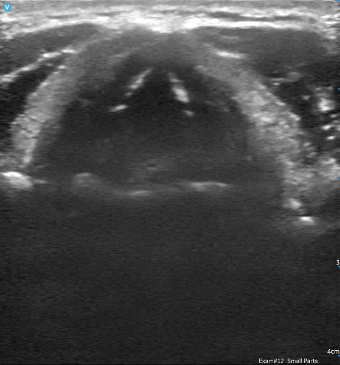 alwood1011's tweet photo. Interesting new use for #vscanair -speech therapists @SltUltrasound using it to examine the vocal cords. 1st image shows tongue, fizzy water and the palate. 2nd shows vocal cords and arytenoids. #QueenSquareSpeechies #VscanAirFirstLook https://t.co/H2aaK08NEZ