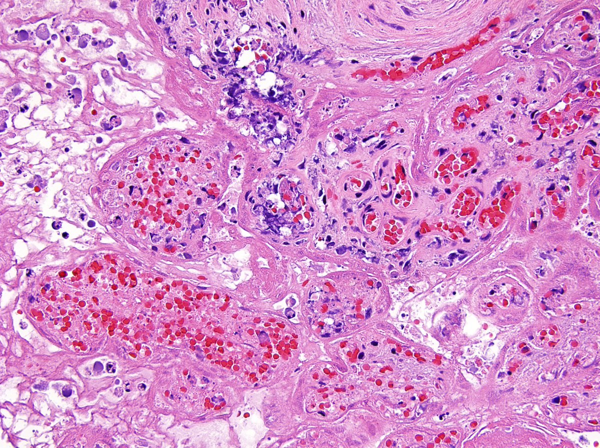 DrEstherAdler's tweet photo. Once upon a time a placental abruption resulted in an emergent C/S and a healthy baby born with APGARS of 8 and 9. Love the OB/GYNs who send me these specimens! What are the findings in below pics? #OBYGN #GYNpath #placenta #MedEd #NYUpathology @nyugrossman https://t.co/uxSKQN993j