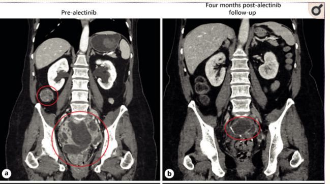 Great case of precision medicine in a #LMS patient we treated. ALK fusion detected, however no response to crizotinib. Patient underwent other chemo, VEGF tx with progression, considered for hospice. Decided to try 2nd gen ALK inhibitors, alectinib, with robust response.