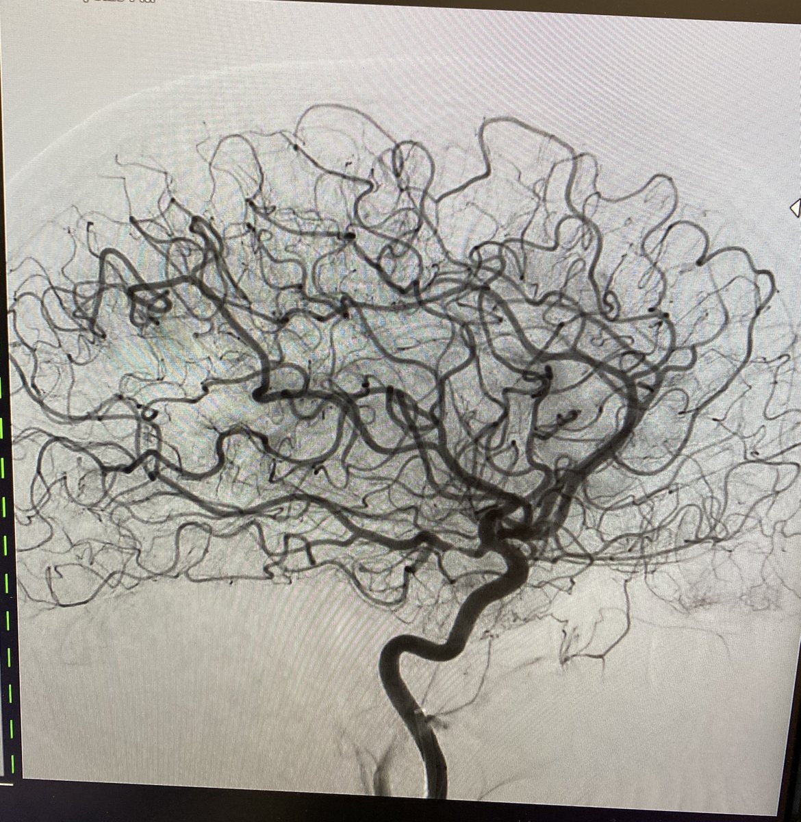 VascNeuro's tweet photo. 64M, LWK 30 min prior to ED admission, presenting NIHSS 18, CT confirmation of RT hyperdense MCA clot. TPA started in CT. Mechanical thrombectomy performed, TICI 0 to 3, with a single pass. #timeisbrain #stroke #neurology https://t.co/qB2Sjk0xKP