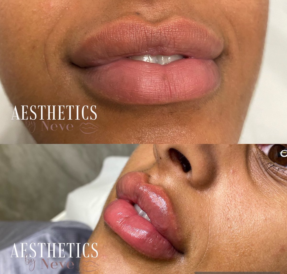 neveltlejohn's tweet photo. I’ve recently just started my own business, as an aesthetic nurse. I offer derma filler - lips and line reducer (botox). I’m looking for models at discounted price so I can build up my Instagram page, if anyone could share this I would really appreciate any help I can get🤍 https://t.co/JC6pokzDlf