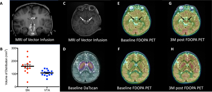 MR-guided direct delivery of gene therapy for #AADC-deficiency leads to clinical benefit in pediatric patients.  Findings in Nature Communications doi.org/10.1038/s41467….

#neurosurgery #GeneTherapy