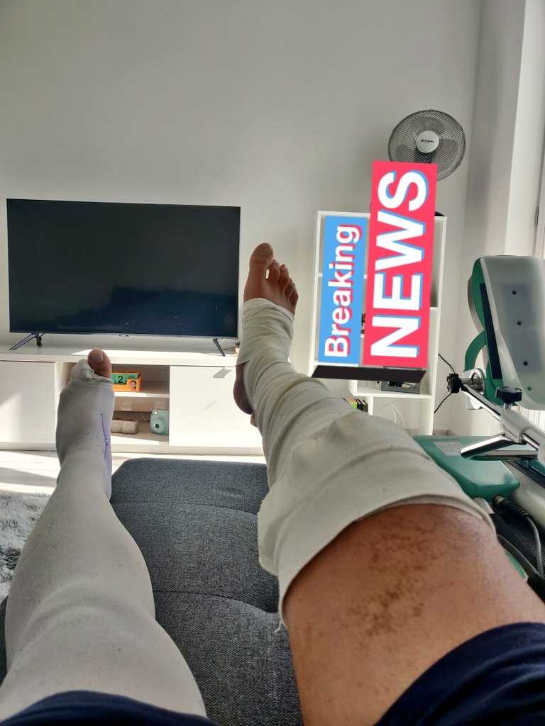 kireetpatri's tweet photo. Weird flex but okay moment: Quads finally firing. Was able to do a straight leg raise 12 days after surgery. Knee flexion up to 75 degs.

Next step: Reach 90 degrees flexion and get off those crutches! 🦵 #ACLStrong https://t.co/ZiEiCrqIoy