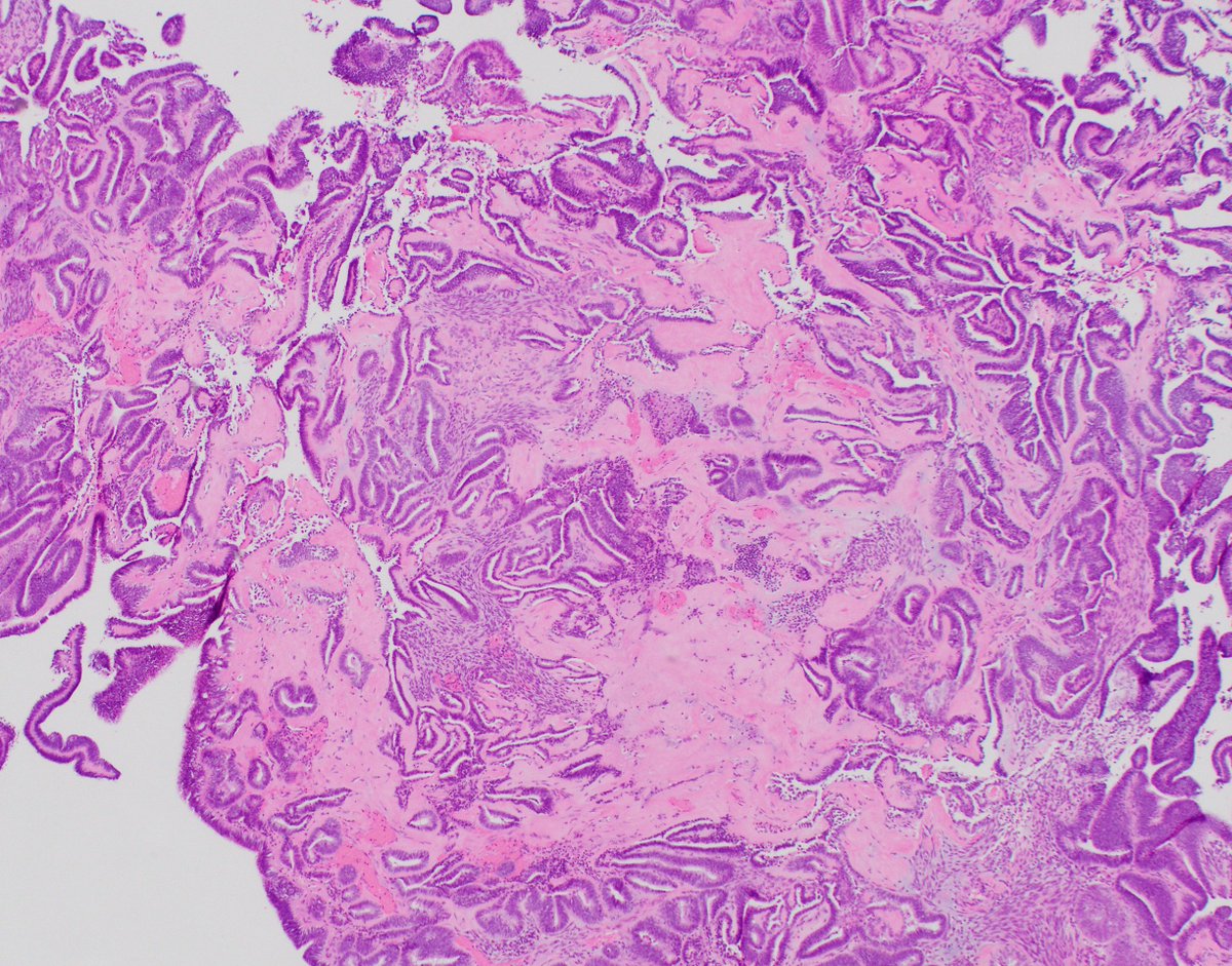 HubertLauMD's tweet photo. One of my favorite diagnoses in #GynPath: corded and hyalinized endometrioid carcinoma (CHEC)

⚠️Not to be confused with carcinosarcoma

Corded/hyalinized/spindled component of CHEC shows:
▶️Low-grade cytology similar to glandular component
▶️Wild-type p53
▶️Nuclear beta-catenin https://t.co/p1AFn7pLVD