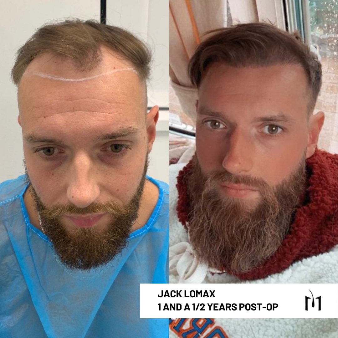 🤯 One Year Hair Transformation - Jack Lomax
⁣
#TuesdayTransformation 🎉 What amazing results from Jack’s hair transplant 12 months ago! ⁣⁣⁣
⁣⁣⁣
If you would like to start your hair journey, our inboxes are open 💬📥⁣⁣
⁣⁣
#DrMatee #DrMateeOfficial #KSLClinic #FUE