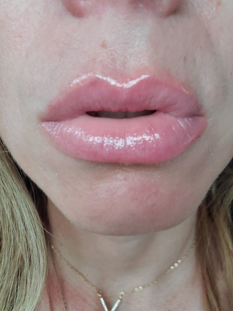 Before....and after 🤩

I loveeeee this lip plumper! Who wants to try it ?

Link to grab yours now while it's in a bundle deal..or seperate 👇
youniqueproducts.com/KBcosmetics/#.…