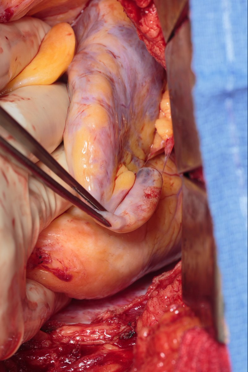 Arman Arghami (@arghami) on Twitter photo Left atrial appendage hernia (out of pericardium) with resultant aneurysmal enlargement and clot.
<a href="/akillumd/">Ammar Killu</a> Left atrial appendage hernia (out of pericardium) with resultant aneurysmal enlargement and clot.
<a href="/akillumd/">Ammar Killu</a>
