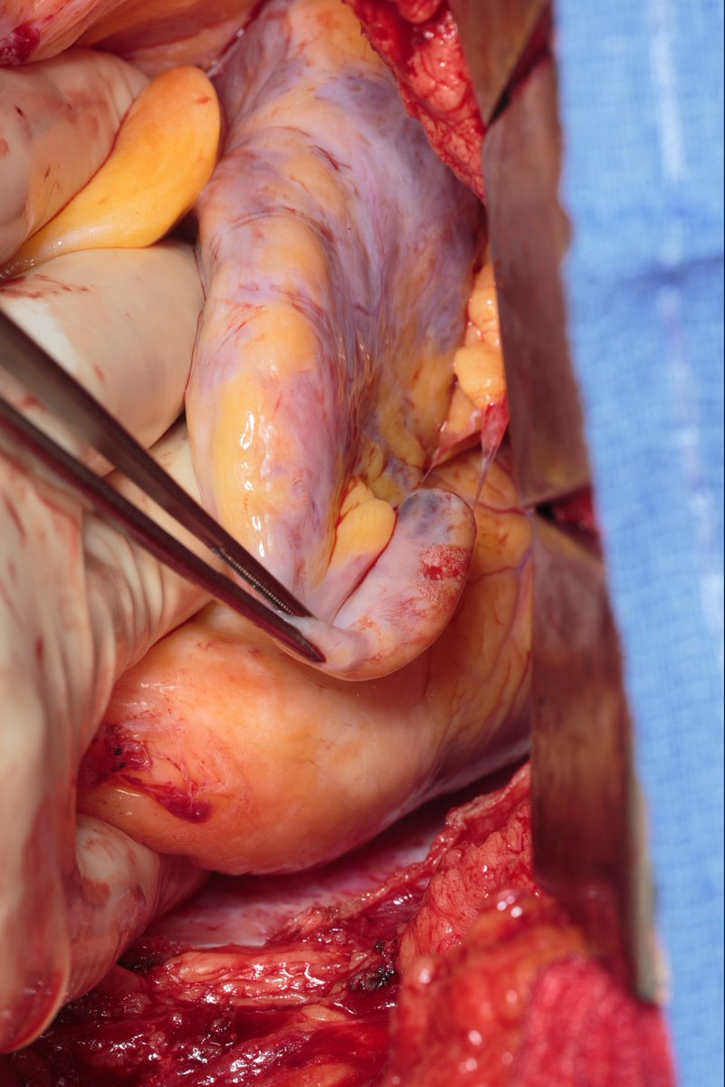 Left atrial appendage hernia (out of pericardium) with resultant aneurysmal enlargement and clot. @akillumd