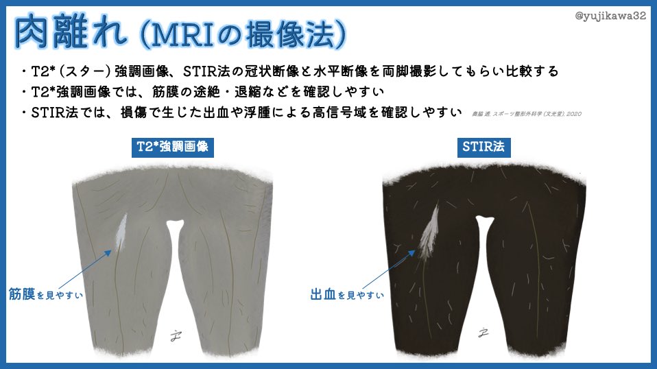 ユジカワ 整形dr イラストレーター Mriは撮影時間も長いし項目も多岐にわたるので なるべく検査 技師さん任せにせず 目的とした撮像法を指定してオーダーすることも大切 特に肉離れではこれだけ撮ってもらえれば十分診断できる 肉離れ Mri