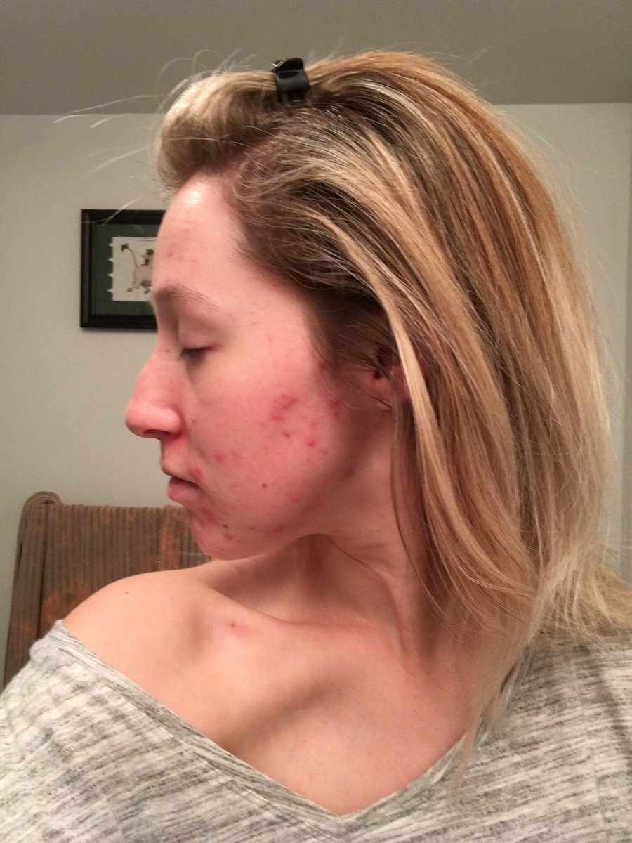 Buy Accutane Ireland