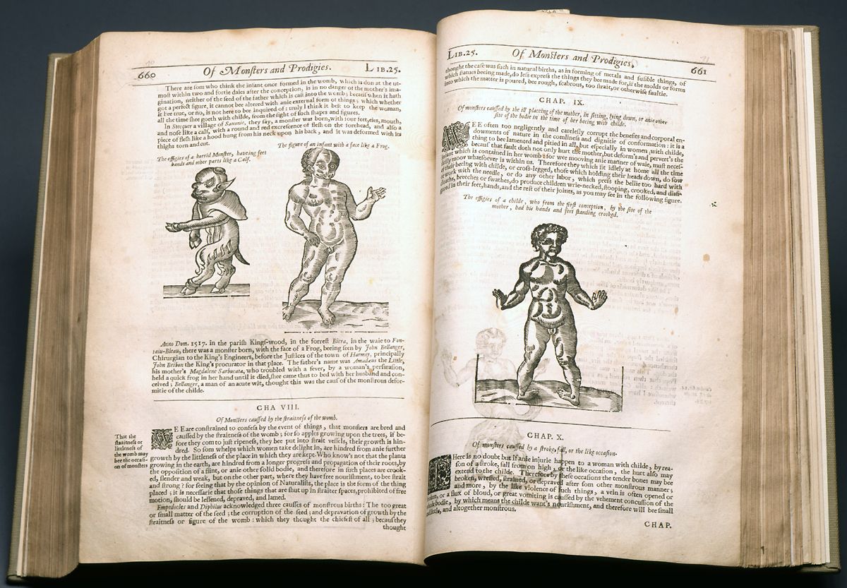 Ambroise Paré (1510–1590): First surgeon to teach use of ligatures in preventing haemorrhage from blood vessels in trauma and in limb amputation. #histsurg #historyofsurgery #Trauma