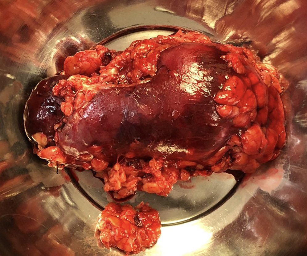 umaemac's tweet photo. Nefrectomía radical derecha en Tumor de riñón derecho T3a N0 M0 EC III #urology #UroSoMe #kidneycancer #urolife https://t.co/gYcjZxlrHq
