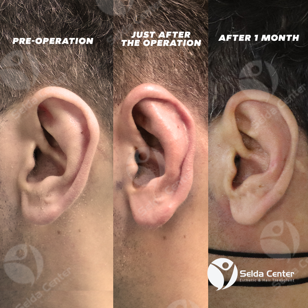 CenterSelda's tweet photo. 👉We save our patients who apply with the complaint of #prominentears, regardless of whether they are men, women or children, with an operation performed under #localanesthesia from this problem.

#otoplasty #otoplasti #kepçekulak #kepçekulakoperasyonu #kepçekulakameliyatı https://t.co/9flUVb42O5
