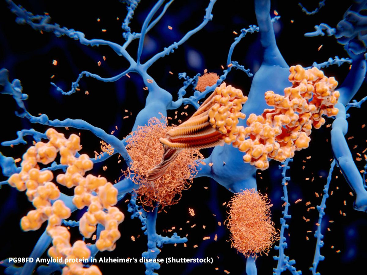 New hope for Alzheimer's patients @MiladAlucozai - mailchi.mp/7c5e995e20d3/g…