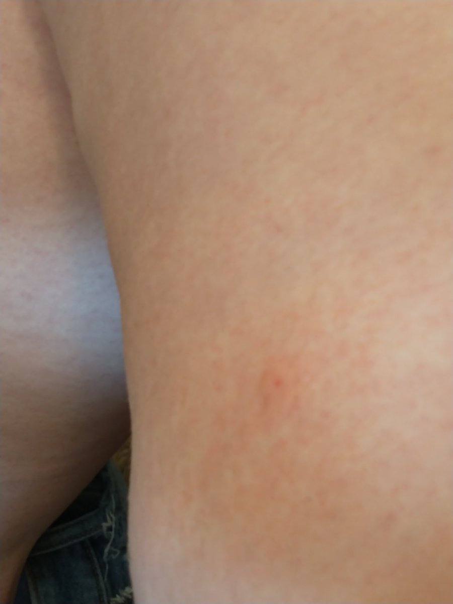 LittLadyLillith's tweet photo. I got in a fight with a wasp. Fuck bugs https://t.co/hcmgfz0vHG